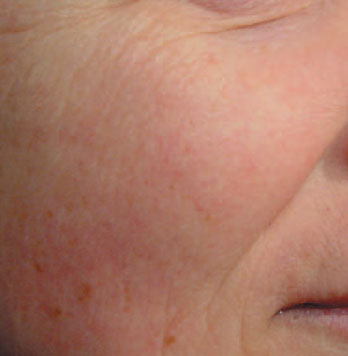 6回目の治療から7週間後 顔全体に約7000パルス