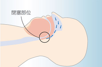 CPAP療法開始1